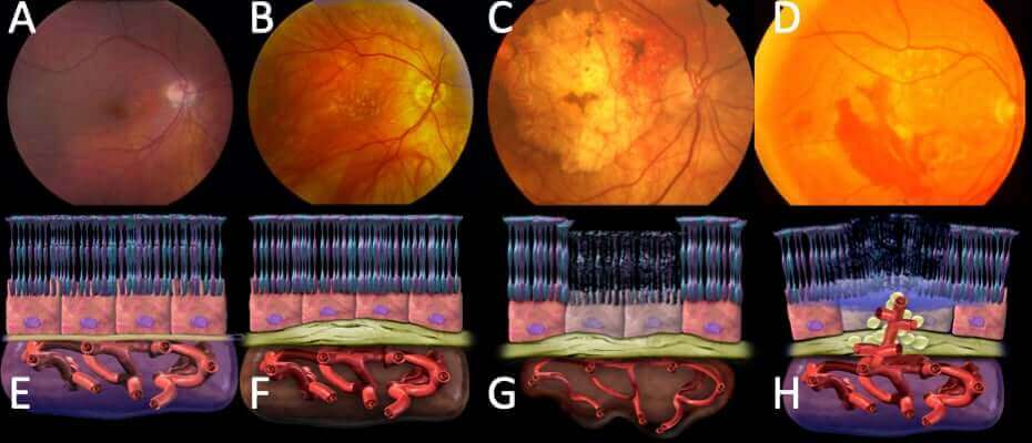 Age Related Macular Degeneration Amd Specialists Rcsd