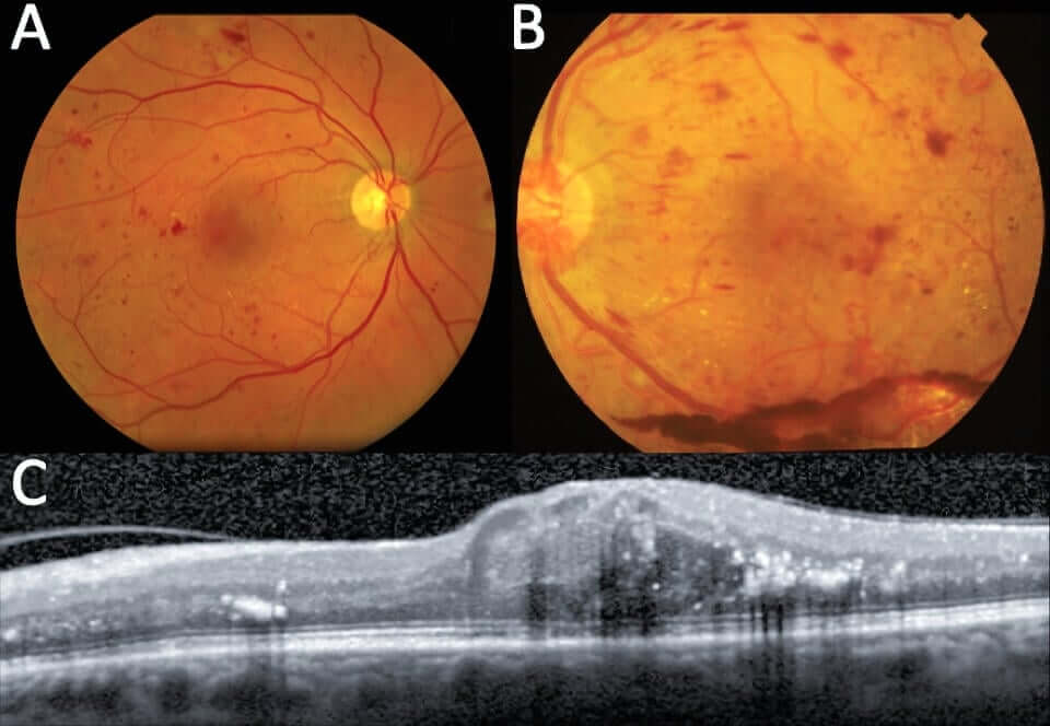 Diabetic retinopathy macular edema