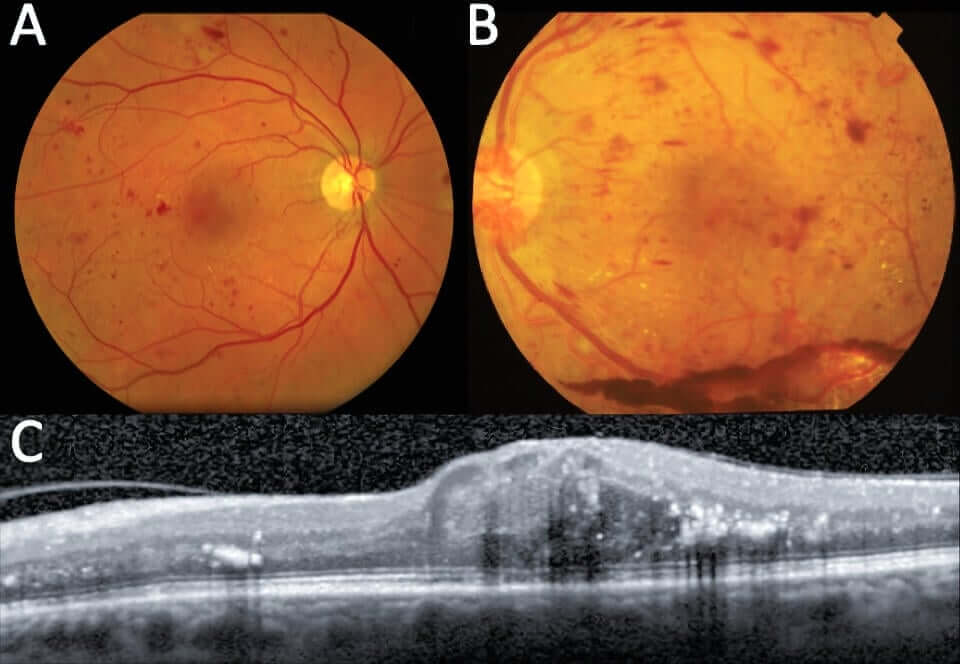 Color photos and OCT scan showing the various stages of diabetic retinopathy and diabetic macular edema.