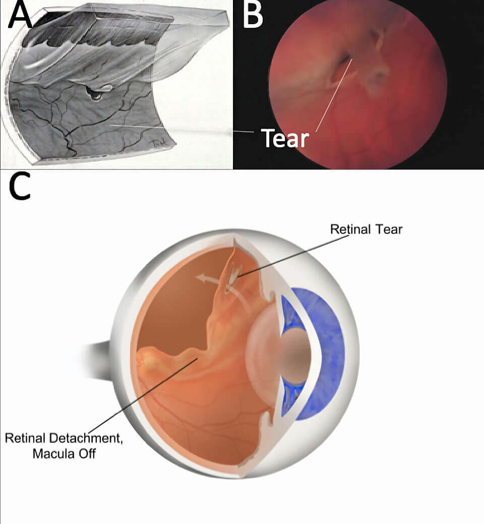 Retinal Detachment - Vitreo-Retinal Consultants