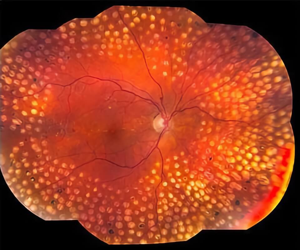 Retinal Neovascularization